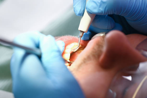 Best Dental Abscess Treatment in San Miguel, CA